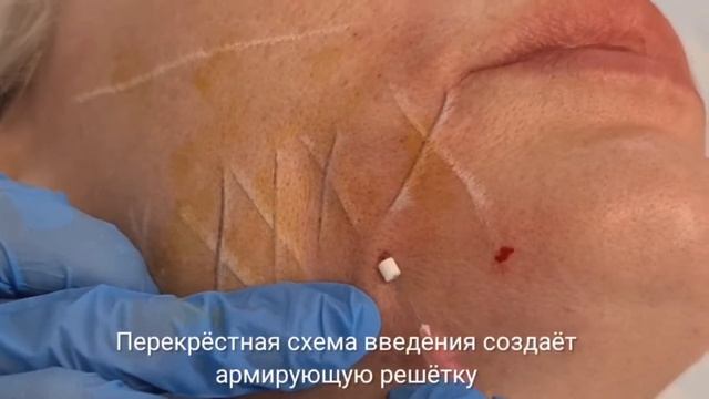 Представляем новинку: подтяжка нитями Aptos Excellence Visage смотреть онлайн