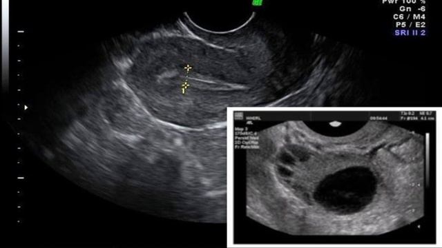 How to check egg size to conceive naturally in Urdu/Hindi смотреть онлайн