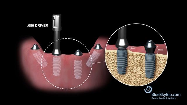 Blue Sky Bio Multi Unit Abutment смотреть онлайн