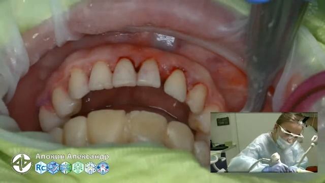 Professional oral hygiene - case 004 Acteon, DTE, Dentsply, Coxo, Floweis, 3M, KerrHawe (livestream смотреть онлайн