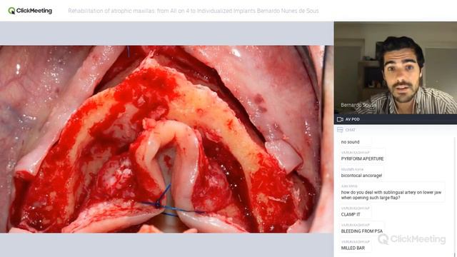 From All on 4 to Individualized Implants Bernardo Nunes de Sousa смотреть онлайн
