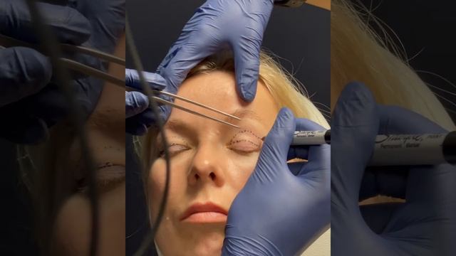 Upper Blepharoplasty + Brow Lift - 1 Week Results - Dr. Anil Shah смотреть онлайн
