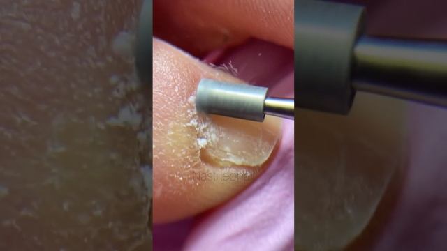 Фреза цилиндр убирает птеригий #nails #педикюр #pedicure #курсыпедикюра #pedicura #кутикула смотреть онлайн