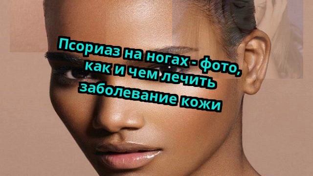 Псориаз на ногах - фото, как и чем лечить заболевание кожи