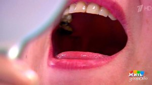 Пробки в миндалинах. Жить здорово! Фрагмент выпуска от 26.01.2017