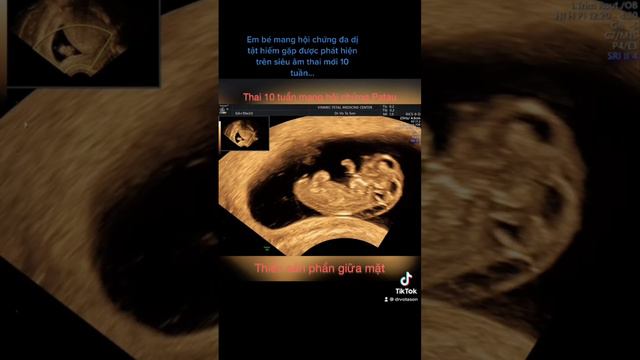 Hội chứng Patau, trisomy 13 ở thai nhi 10 tuần смотреть онлайн