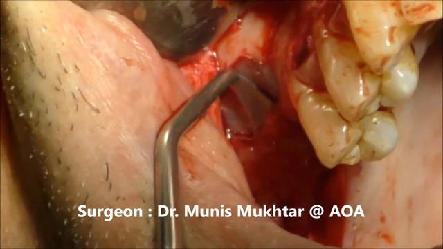 Sinus Lift Using Lateral Window + Implantation. смотреть онлайн