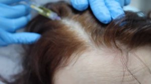 Мезотерапия для волосистой части головы