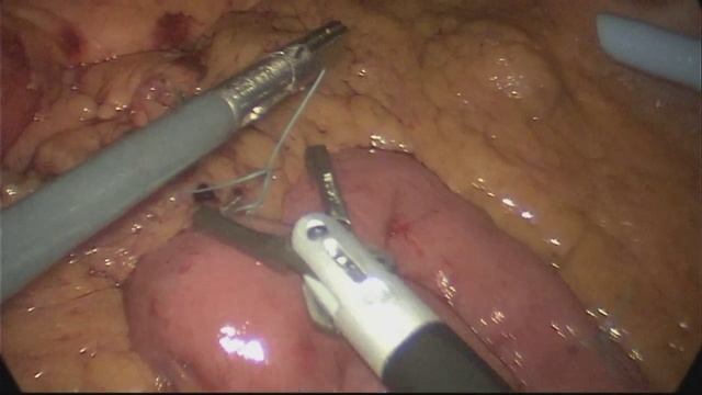 Robotic Distal Subtotal Gastrectomy with Modified D2 Lymph Node Dissection смотреть онлайн