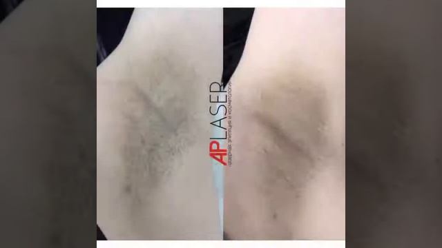 Лазерная эпиляция подмышек смотреть онлайн