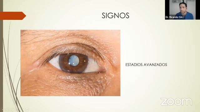 Catarata senil смотреть онлайн