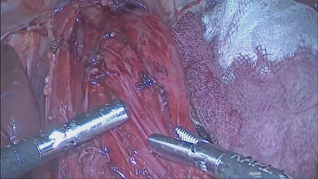 Laparoscopic Heller's Cardiomyotomy & Dor fundoplication for Achalasia Cardia - Dr. J. K. A. Jameel смотреть онлайн