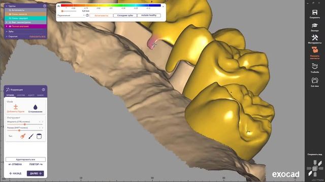 EXOCAD Ответная часть балки из циркона