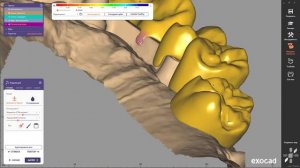 EXOCAD Ответная часть балки из циркона