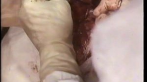 Кесарево сечение © Сesarian section