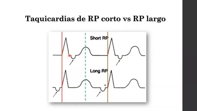 Taquiarritmias(parte 2) смотреть онлайн