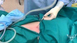 Лапароскопия. Игла Вереша