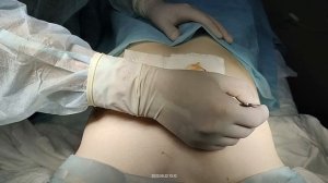 Удаление гинекомастии под наркозом. Султанбаев А.У.