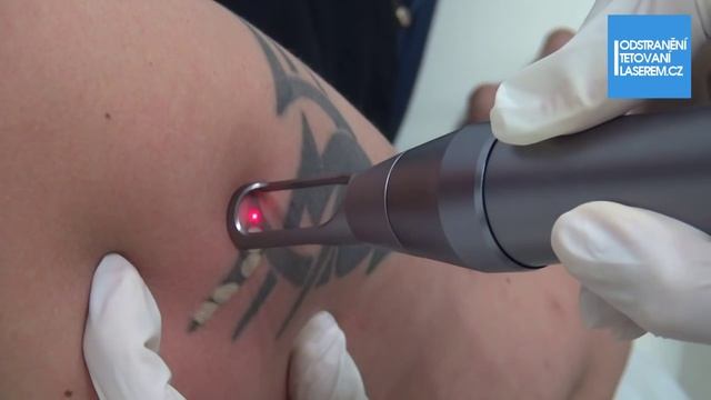 Odstranění Tetování - Ošetření A Rozhovor - Www.odstraneni-tetovani-laserem.cz