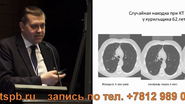 Диагностика рака легкого на КТ смотреть онлайн