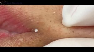 #10 Blackhead Removal / Удаление черных точек online video cutter com