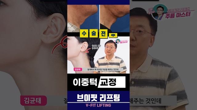 #shorts #이중턱 교정-브이핏 리프팅 [ V-FIT LIFTING ] 목주름 교정 수술 neck wrinkles surgery смотреть онлайн