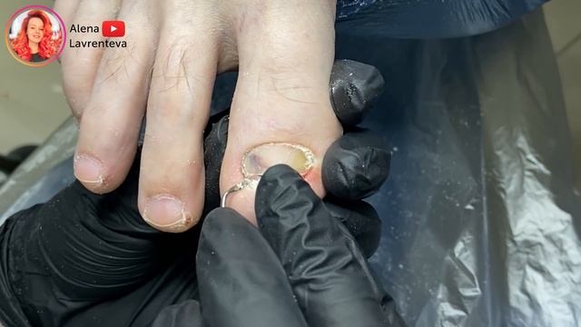 Грибок или не грибок