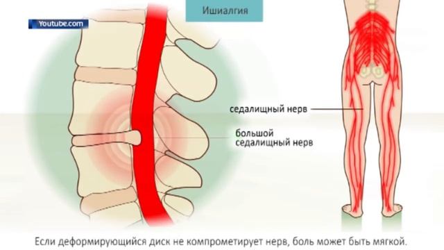 Боль в нижней части спины смотреть онлайн