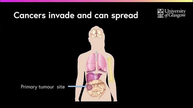 What are the differences between benign & malignant tumours? смотреть онлайн