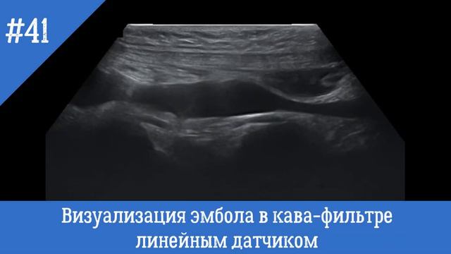 УЗИ сосудов. Визуализация эмбола в кава - фильтре линейным датчиком. смотреть онлайн