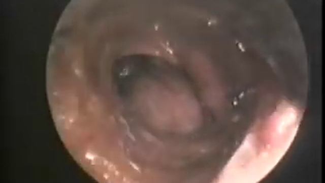 Cervical Mediastinoscopy