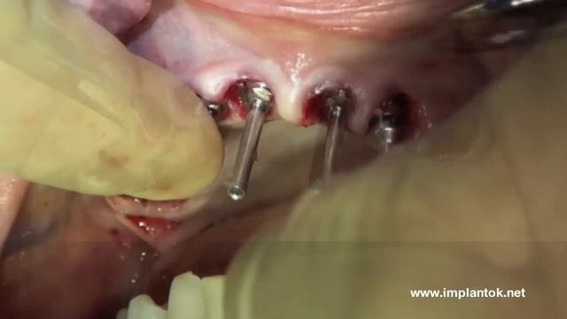Immediate fixed Rehabilitation full arch with Toronto bridge смотреть онлайн