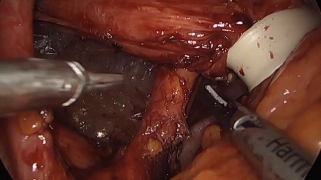 Toupet Fundoplication With Hiatal Hernia Repair - Animation & Actual Surgical Footage