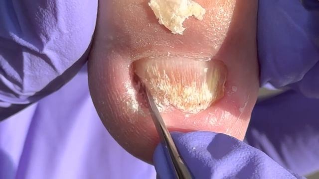 Very Small Deformed Onychomycosis, Dug Out A Large Piece Of Ingrown Nail【Doctor Liu Pedicure】