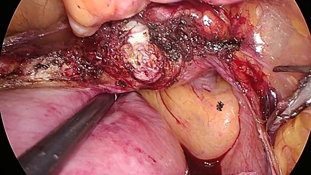сложная матка экстирпация // лапароскопическая гистерэктомия // TLH смотреть онлайн