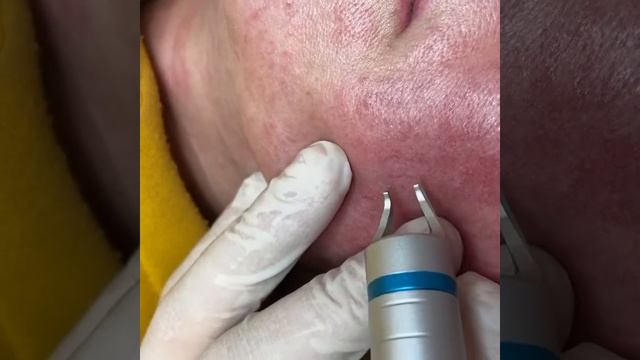 Удаление сосудов на лице диодным лазером 980 nm смотреть онлайн