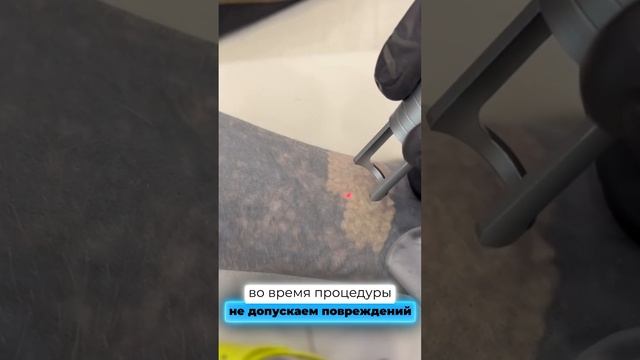 Удаляем черную руку ? #удалениетату смотреть онлайн