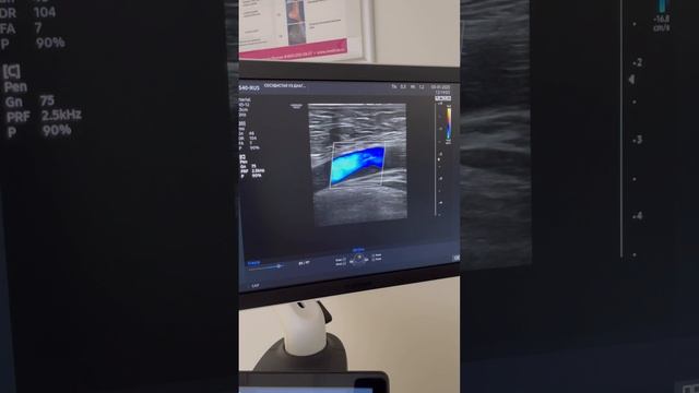 Отложение холестерина в сосудах. Атеросклероз. Узи сосудов. Флеболог Москва смотреть онлайн