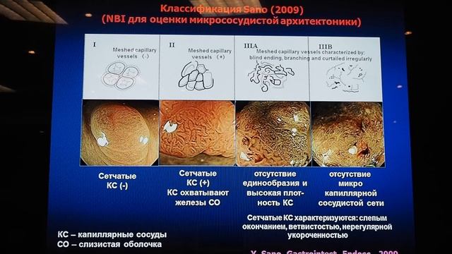 08 Иванова ЕВ Классификации и интерпретация эпителиальных новообразований толстой кишки смотреть онлайн