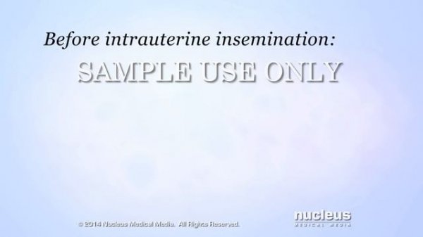 Fertility Treatment: Artificial Insemination (IUI)