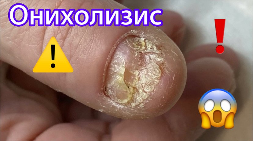 Зачистка онихолизиса ⚠️❗️?? смотреть онлайн