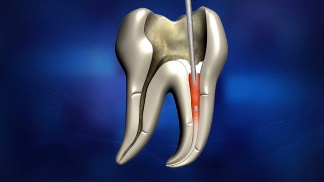 Root Canal Filling Procedure (5min.).wmv смотреть онлайн