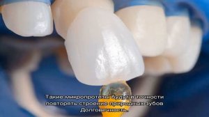 Что такое виниры? Виниры на зубы: плюсы и минусы, фото до и после