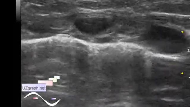 Pediatric Soft tissue ultrasound - Chest wall lesion смотреть онлайн