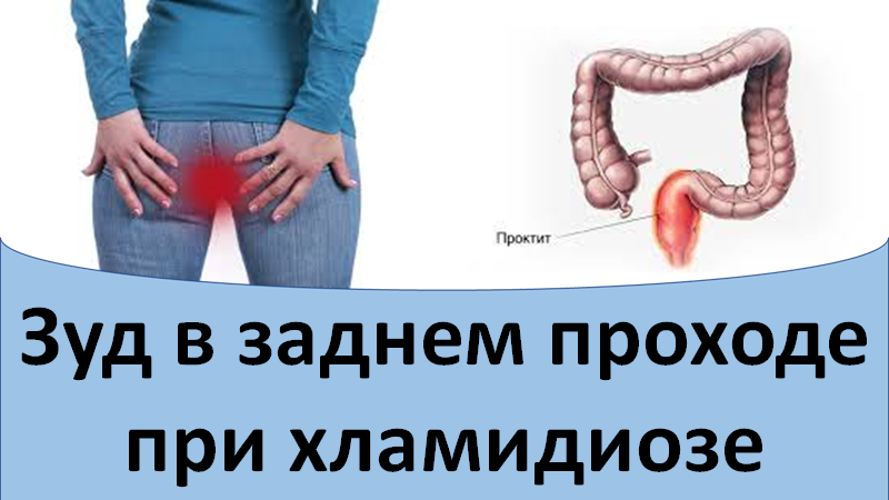 Зуд в заднем проходе при хламидиозе смотреть онлайн