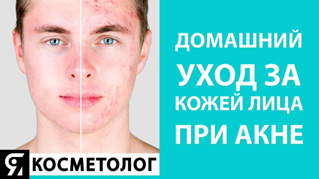 Домашний уход за кожей лица при акне от А до Я. Врач косметолог высшей категории Бычкова Н. Ю. смотреть онлайн
