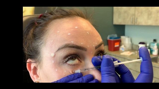 Botox full face training video смотреть онлайн