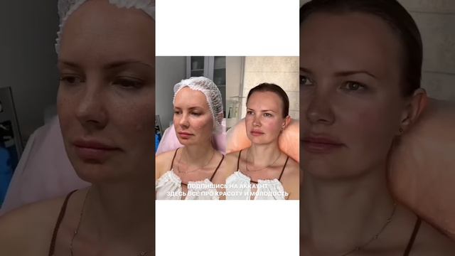 Избавляемся от темных кругов под глазами с помощью филлеров смотреть онлайн