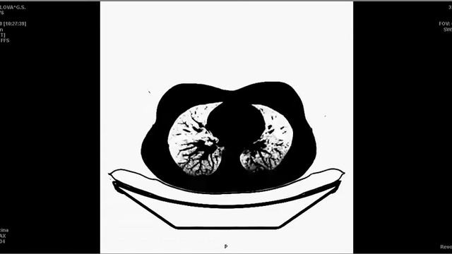 КТ легких в позитиве, начало пневмонии