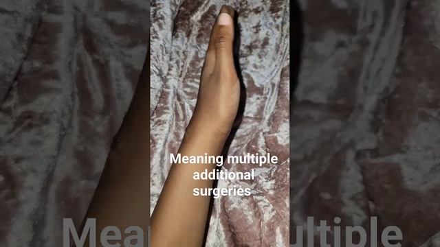 carpal tunnel surgery #myexperience #carpaltunnel #awareness don't do it! 29 day update. смотреть онлайн